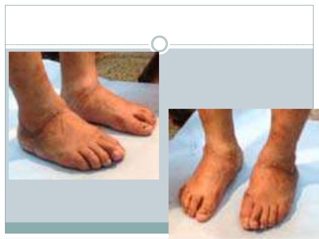 articulacion de charcot